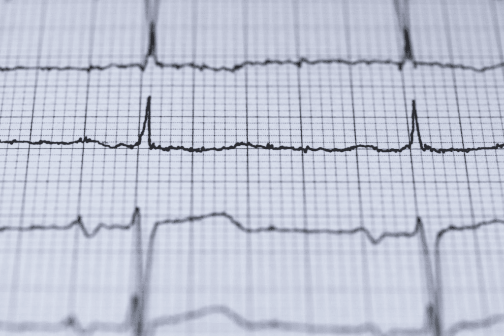 A Electrocardiogram aka EKG graph 